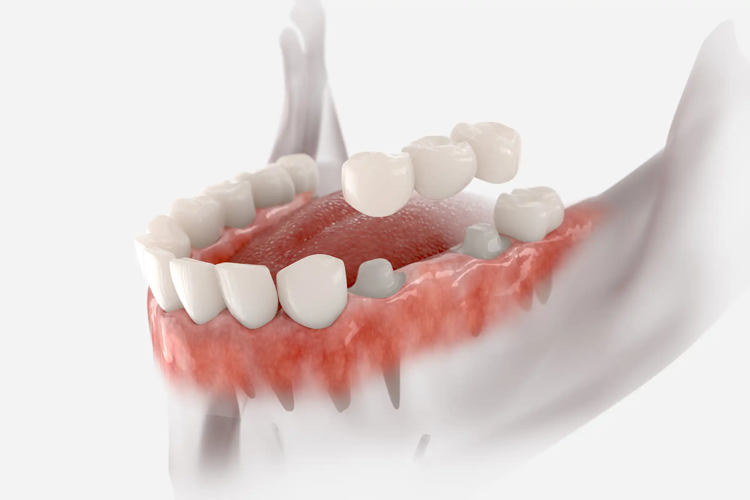 Dental Bridges