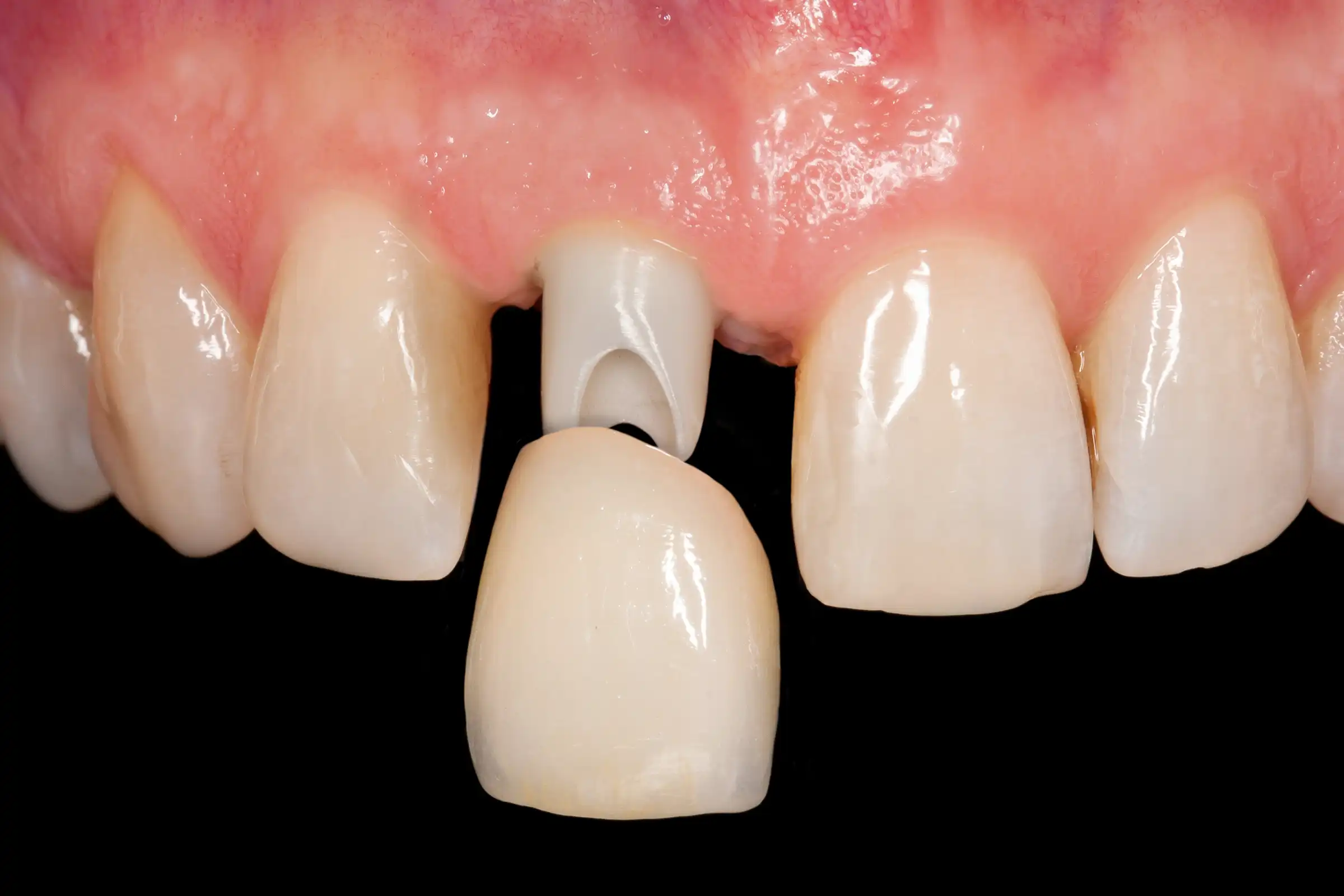 Dental Crowns